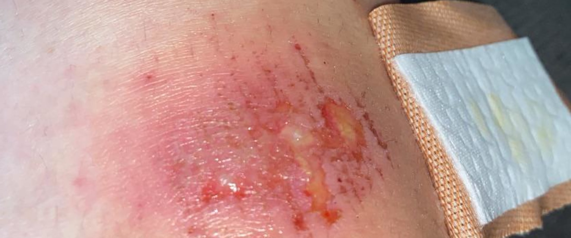 Purulent Fluid: Understanding the Signs and Treatment