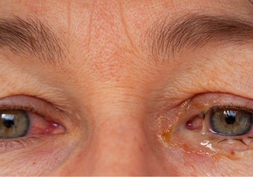 Understanding the Difference Between Mucus and Purulent Discharge: An Expert's Perspective