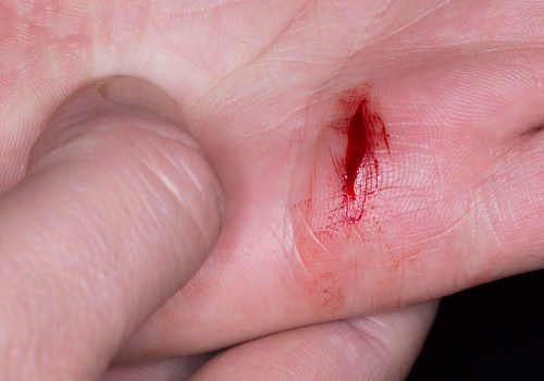 Expert Tips for Proper Wound Drainage and Healing: A Comprehensive Guide