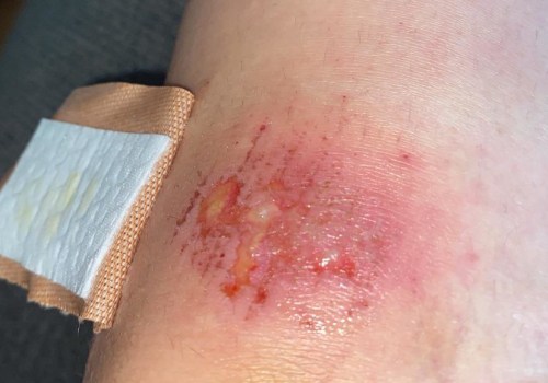 Purulent Drainage: Understanding the Causes, Symptoms, and Treatment