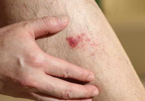 Expert Insights: Managing Purulent Skin Infections with the Right Antibiotic