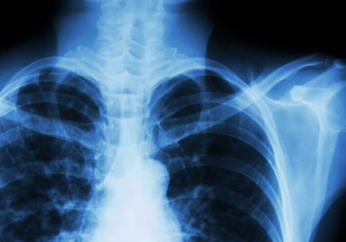 The Truth About the Color of Sputum
