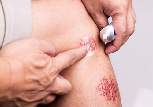 Need an Antibiotic for Wounds? Know When and What to Use