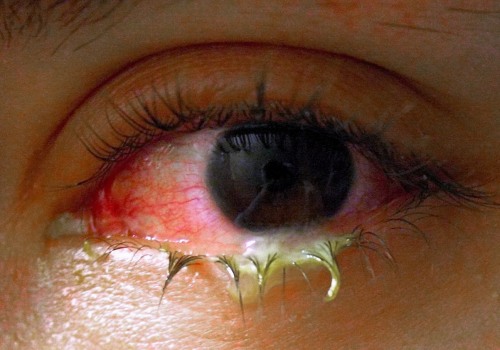 The Dangers of Ignoring Purulent Secretions in Wounds