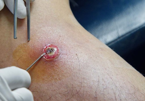 The Healing Process of Abscess Drainage: Insights from a Wound Care Expert