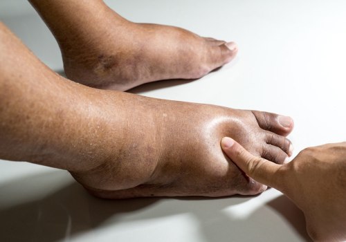 How to Spot Diabetic Foot Gangrene Early Stages Before It Worsens