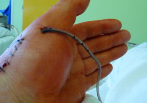 Expert Insights on Purulent Drainage and Wound Management